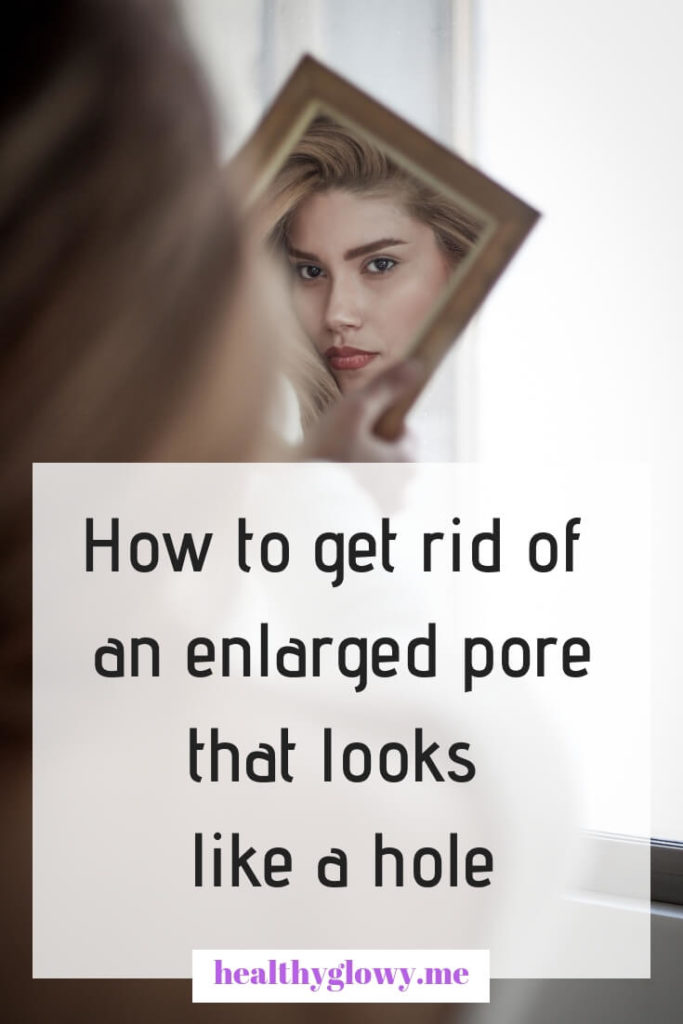 How to get rid of an enlarged pore that looks like a hole